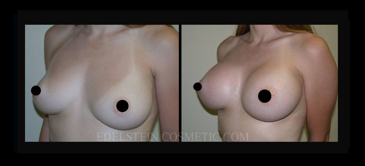 Breast Augmentation case #26817