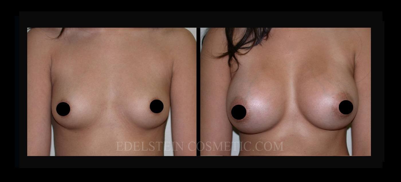 Breast Augmentation case #26814