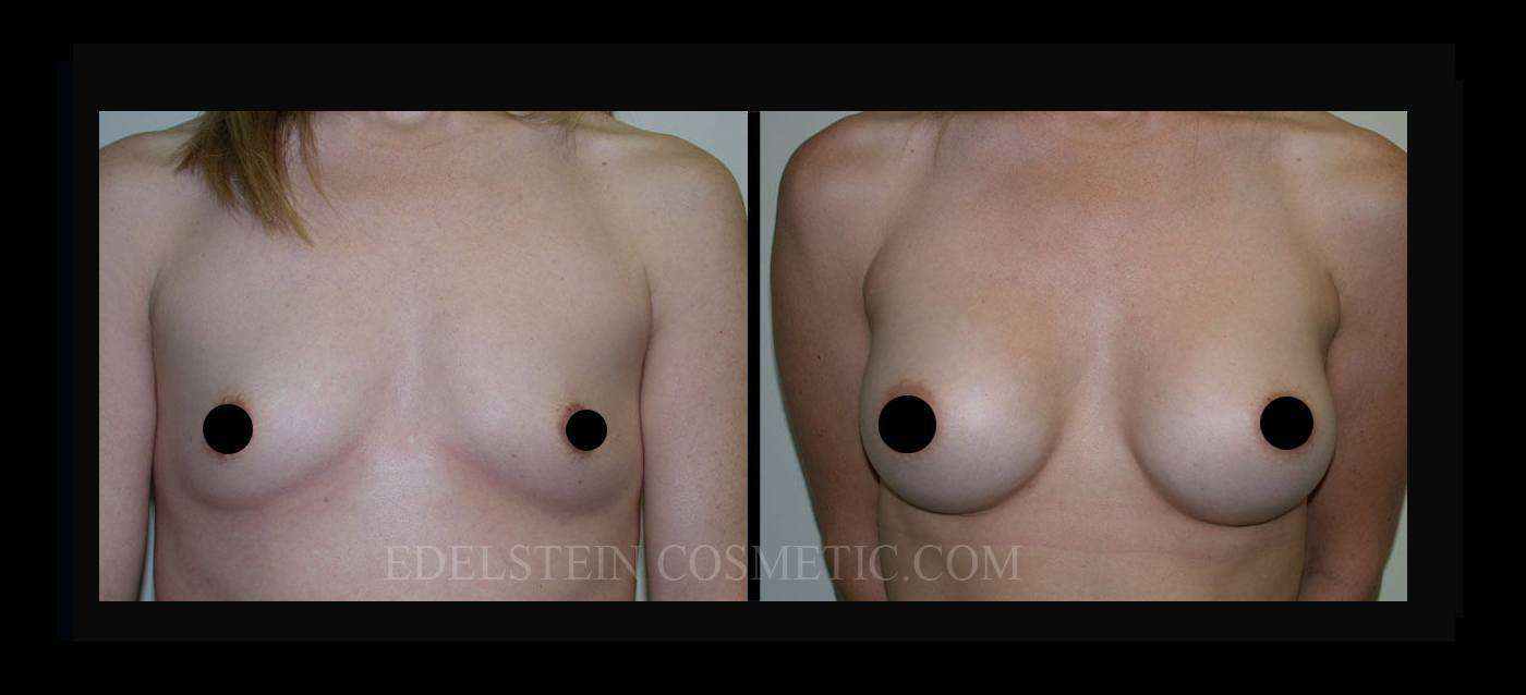 Breast Augmentation case #26811