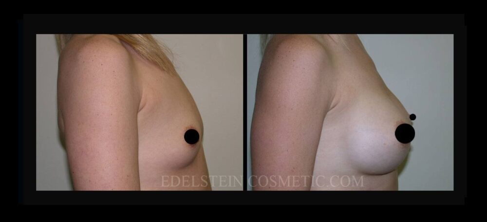 Breast Augmentation case #26811