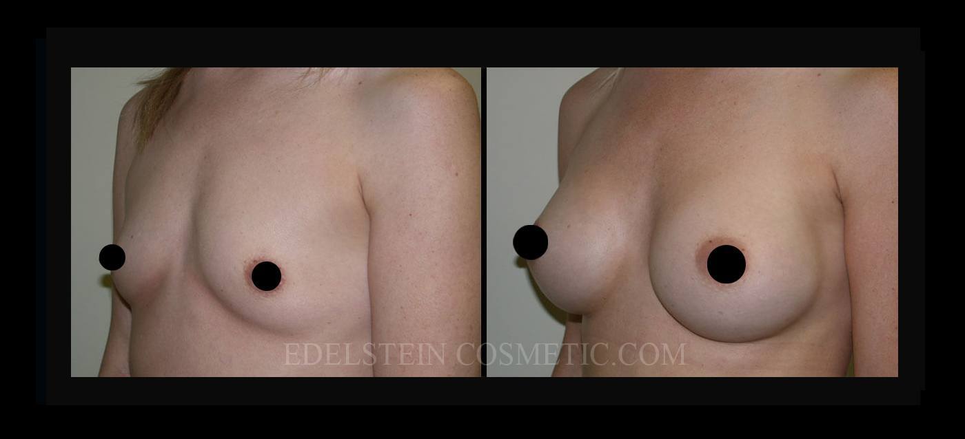 Breast Augmentation case #26811