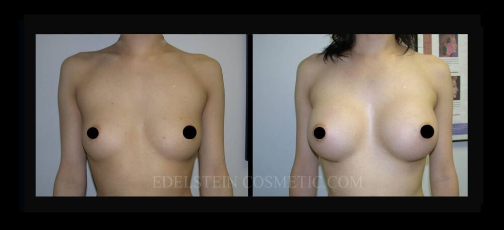 Breast Augmentation case #26809