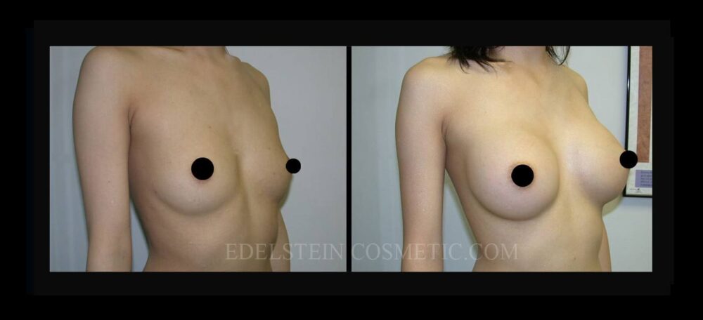 Breast Augmentation case #26809