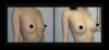 Breast Augmentation case #26809 slider thumbnail