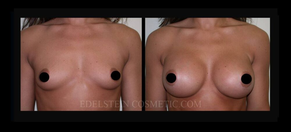 Breast Augmentation case #26807