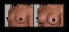 Breast Augmentation case #26807 slider thumbnail