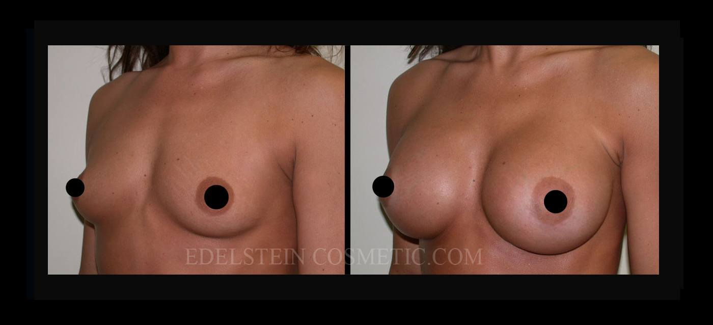 Breast Augmentation case #26807