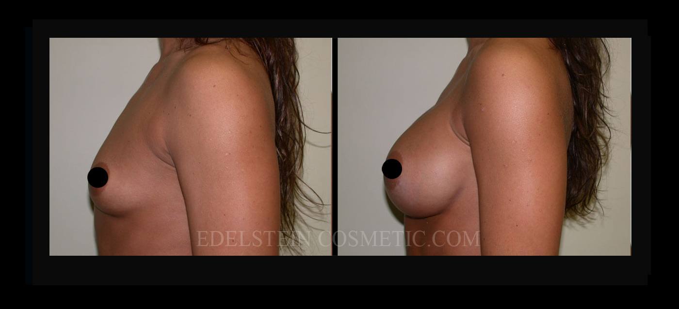 Breast Augmentation case #26807