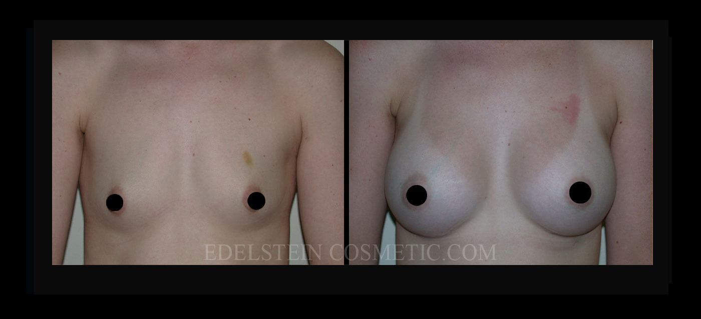Breast Augmentation case #26805