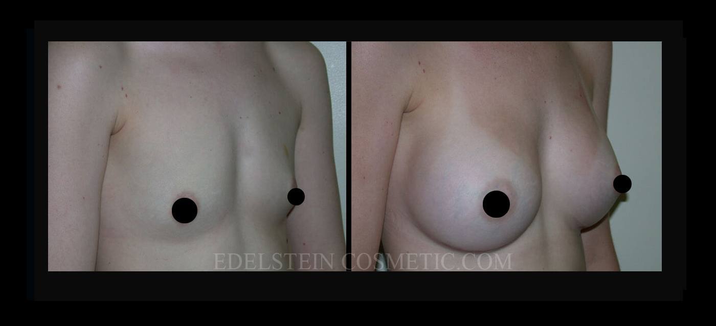 Breast Augmentation case #26805