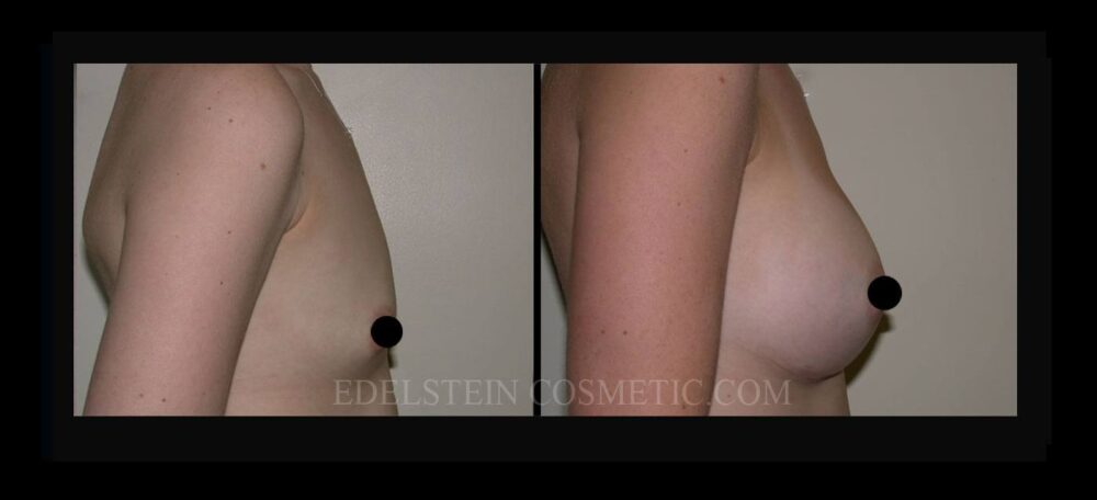 Breast Augmentation case #26805