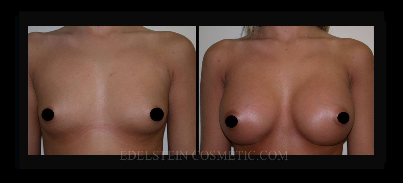 Breast Augmentation case #26801