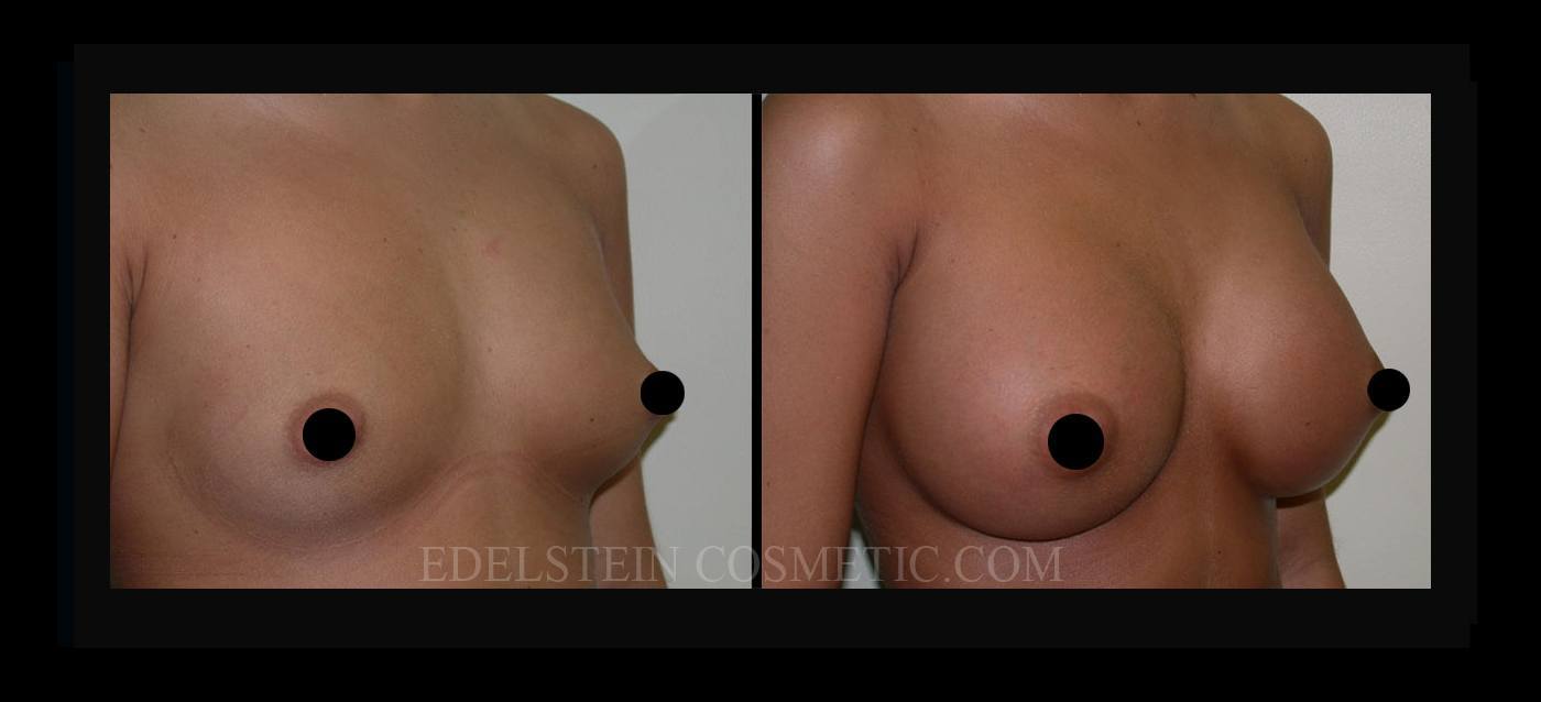Breast Augmentation case #26801