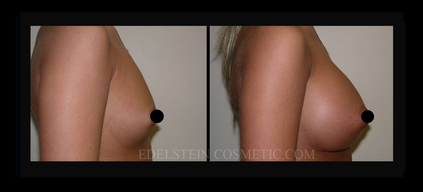 Breast Augmentation case #26801