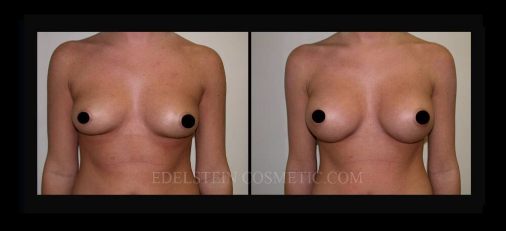 Breast Augmentation case #26799