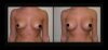 Breast Augmentation case #26799 slider thumbnail