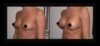 Breast Augmentation case #26799 slider thumbnail