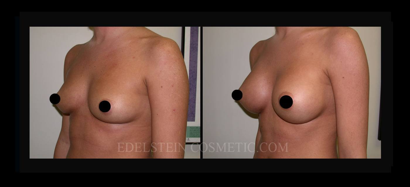 Breast Augmentation case #26799