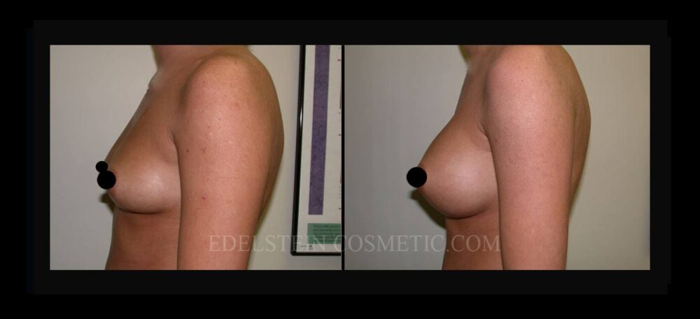 Breast Augmentation case #26799