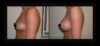 Breast Augmentation case #26799 slider thumbnail