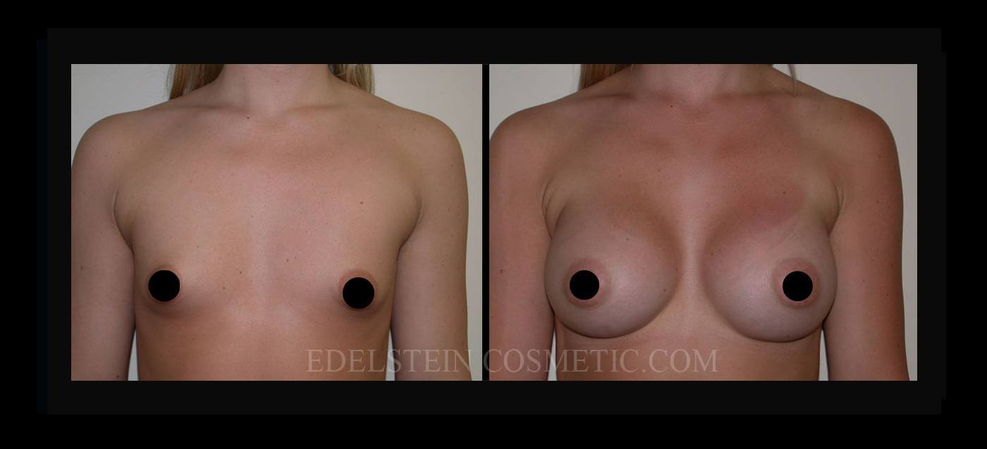 Breast Augmentation case #26798
