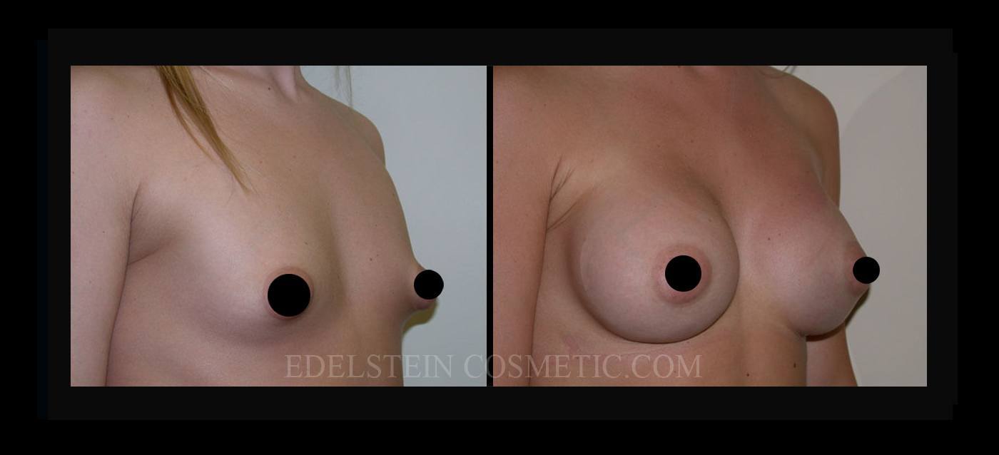 Breast Augmentation case #26798