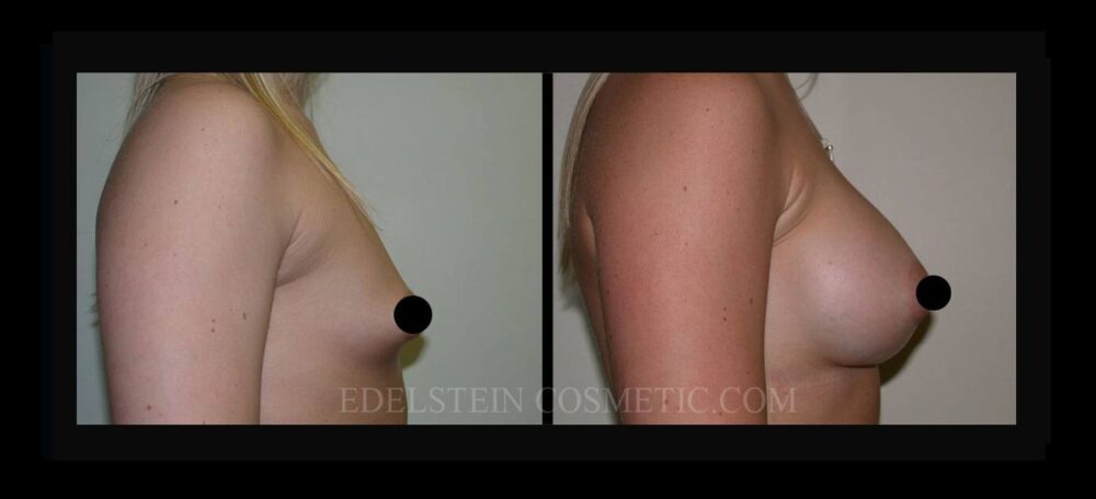 Breast Augmentation case #26798