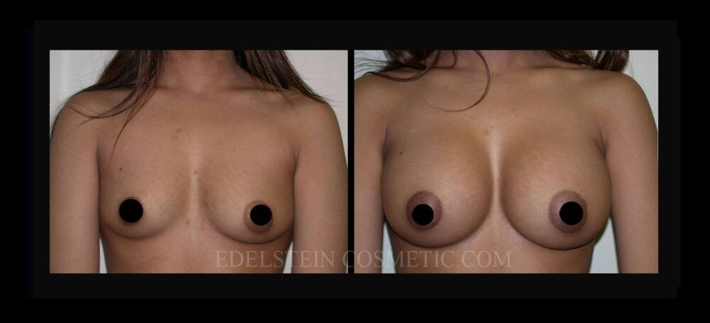 Breast Augmentation case #26797