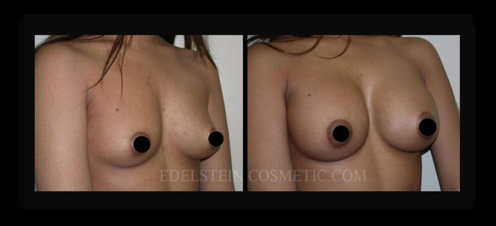 Breast Augmentation case #26797