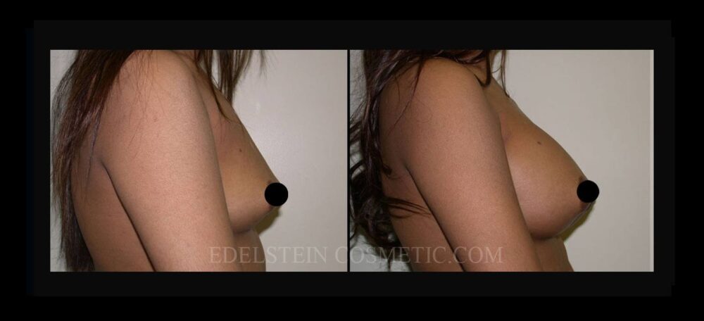 Breast Augmentation case #26797