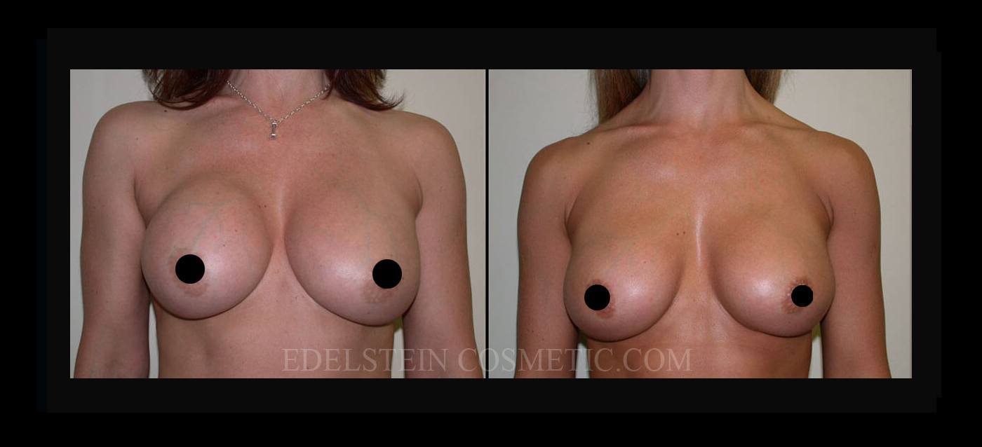 Breast Augmentation case #26795