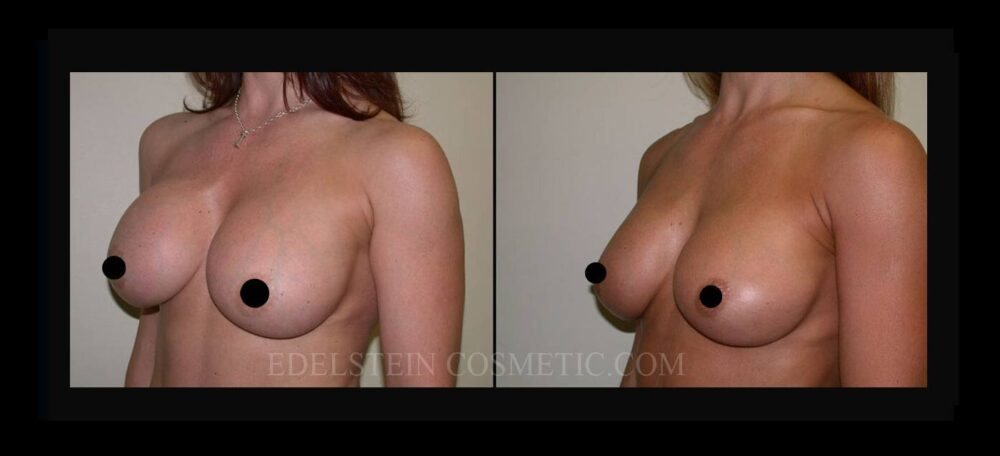 Breast Augmentation case #26795