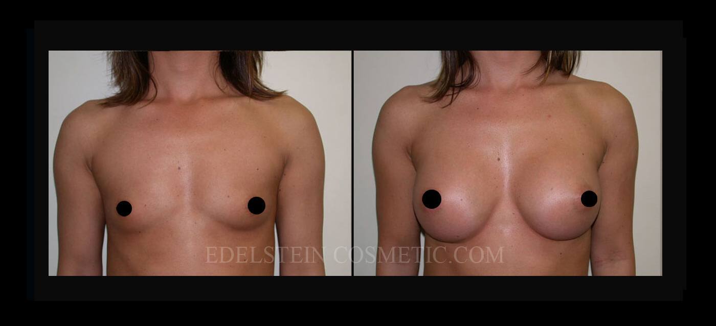 Breast Augmentation case #26793