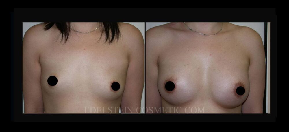 Breast Augmentation case #26791