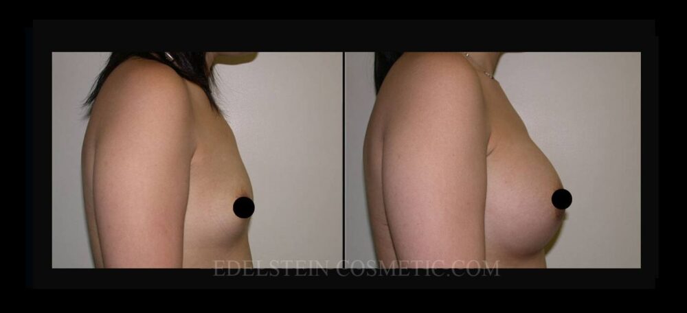 Breast Augmentation case #26791