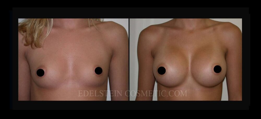 Breast Augmentation case #26789