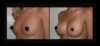 Breast Augmentation case #26789 slider thumbnail