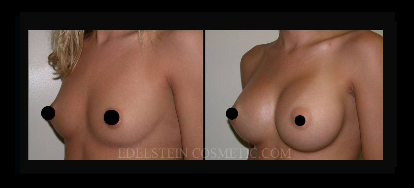 Breast Augmentation case #26789