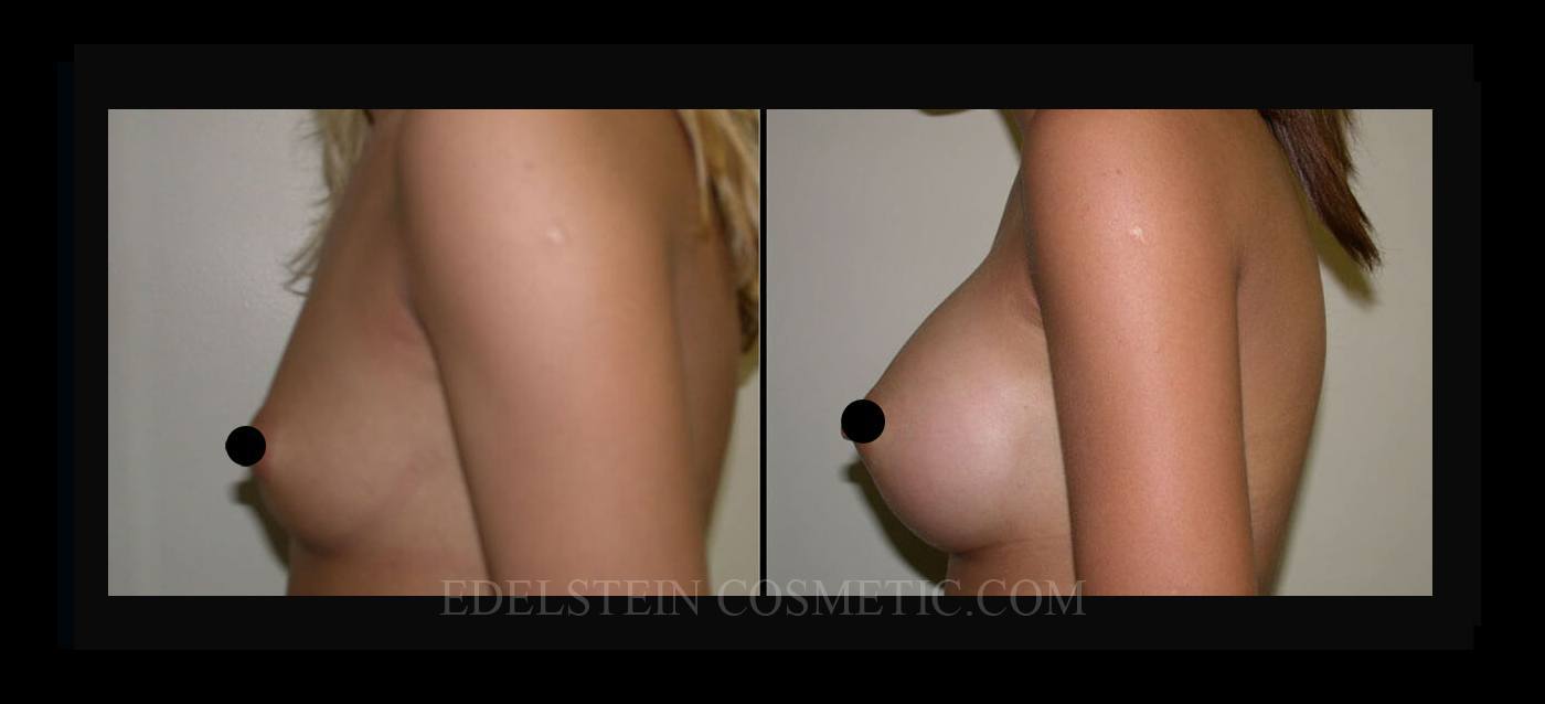 Breast Augmentation case #26789