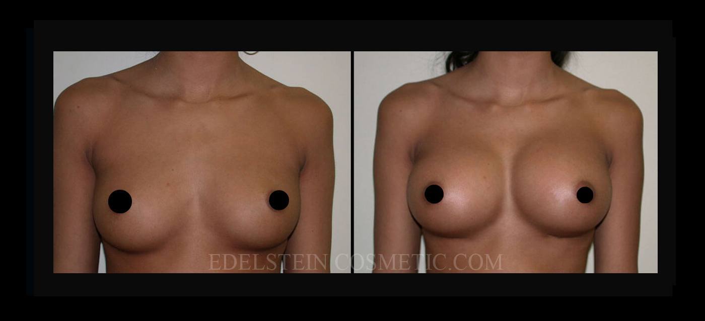Breast Augmentation case #26786