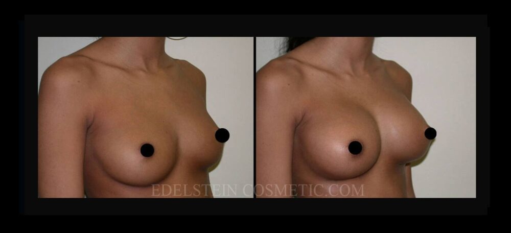 Breast Augmentation case #26786