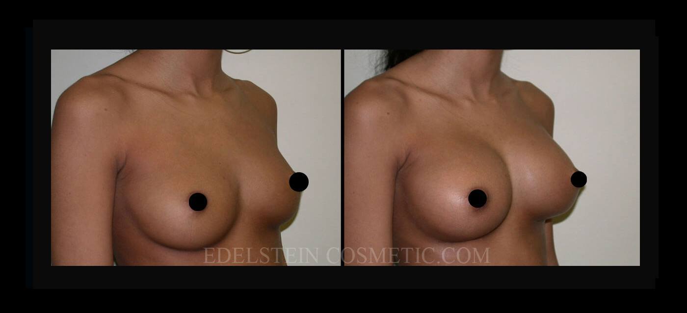 Breast Augmentation case #26786