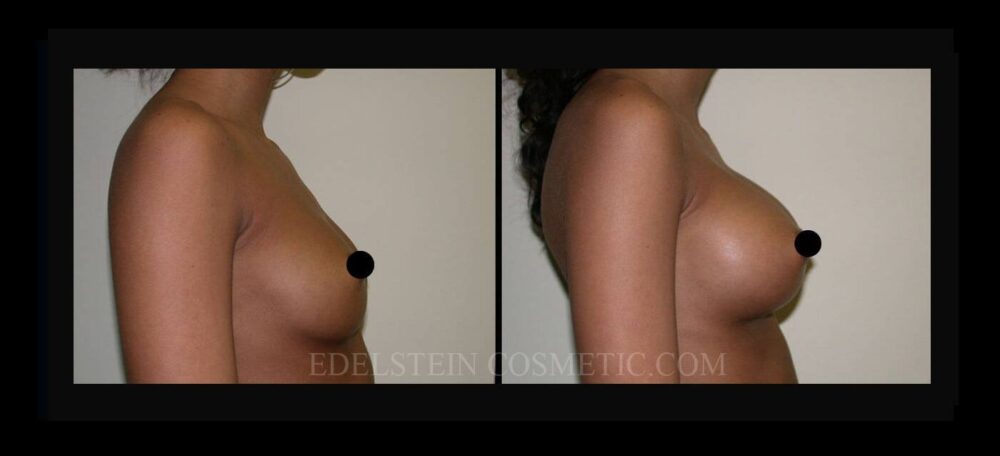 Breast Augmentation case #26786