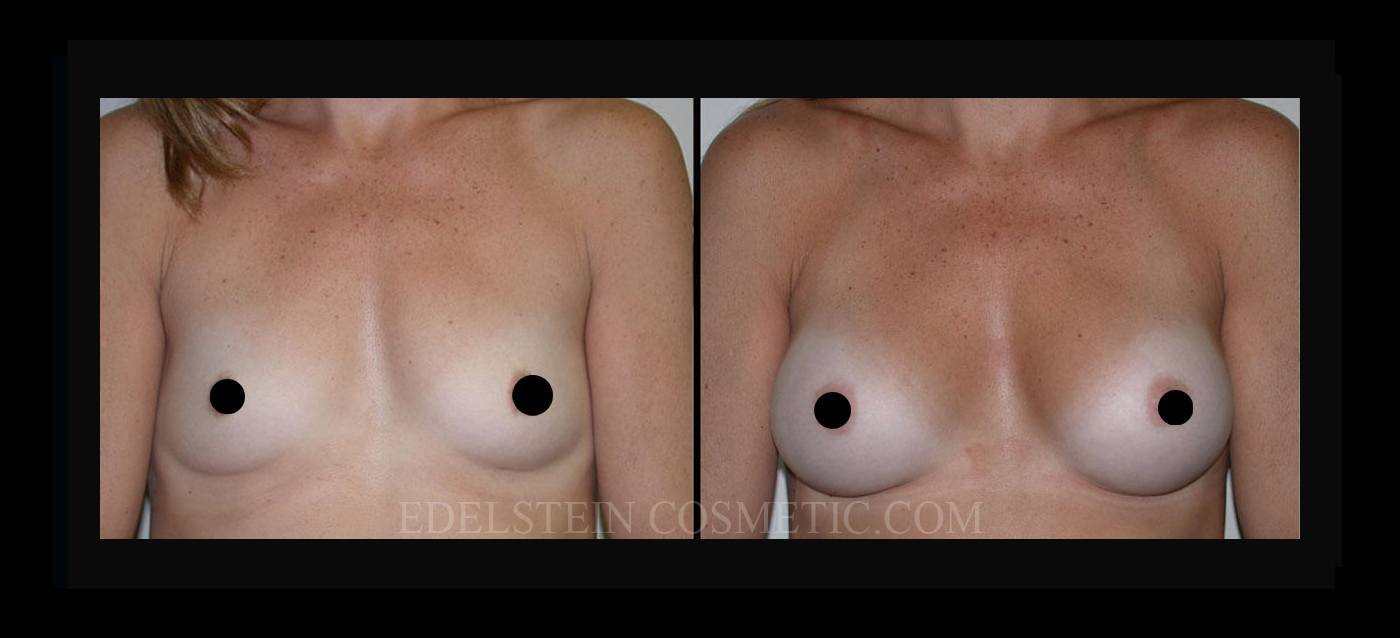 Breast Augmentation case #26780