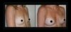 Breast Augmentation case #26780 slider thumbnail