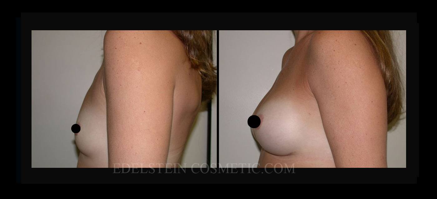 Breast Augmentation case #26780