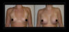 Breast Augmentation case #26778 slider thumbnail