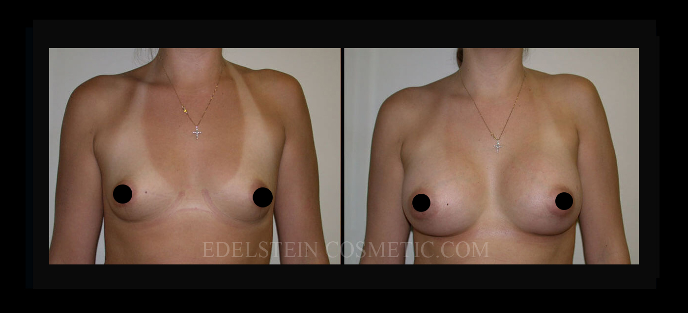 Breast Augmentation case #26778