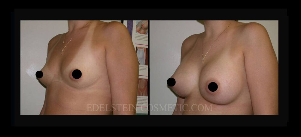 Breast Augmentation case #26778