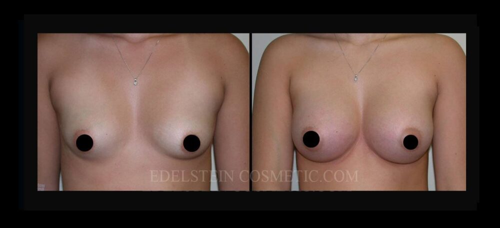 Breast Augmentation case #26776